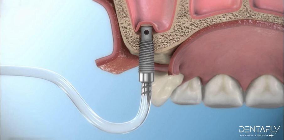 https://www.dentaflyklinik.com/wp-content/uploads/2023/10/kemik-grefti-sinus-lift.jpg